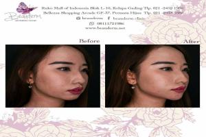 Chin Augmentation / Filler Dagu